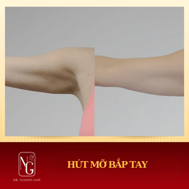 hình ảnh hút mỡ bắp tay